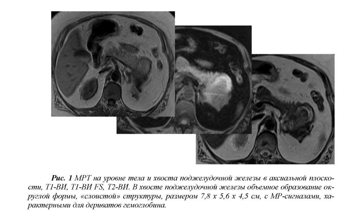 Магнитно-резонансная томография ложной аневризмы селезеночной артерии (случай из практики)