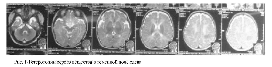 Мигрирующая парциальная эпилепсия у ребенка с гетеротопией мозга (клинический случай)