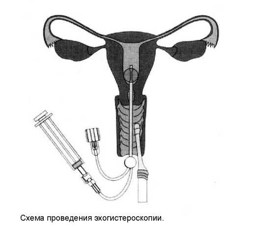 Эхогистероскопия в гинекологии (обзор литературы)