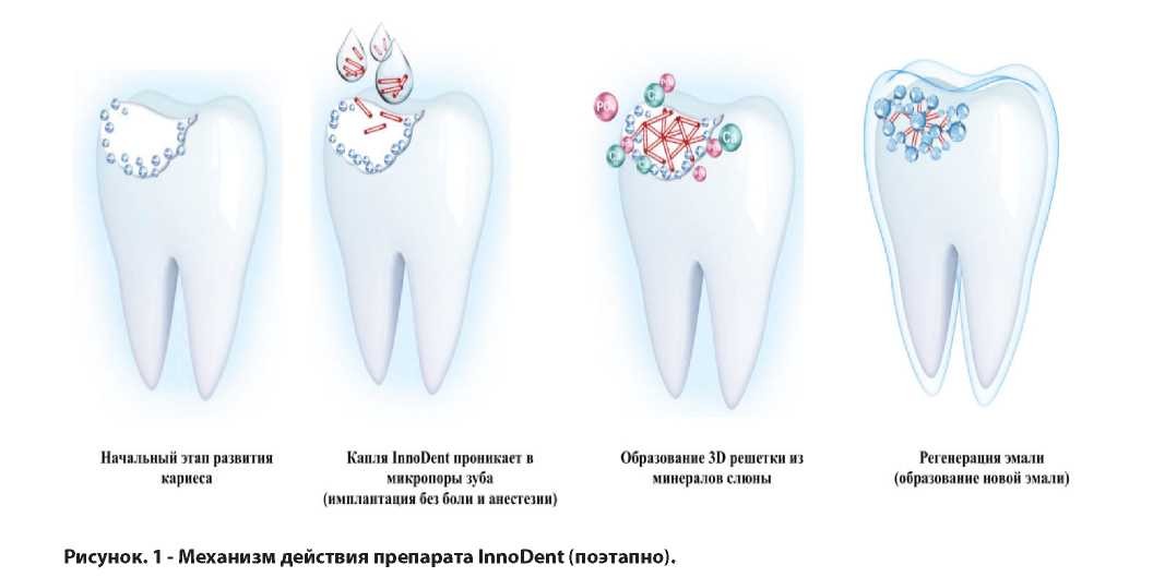 Применение отечественного препарата innodent™ в лечении начального кариеса постоянных зубов у детей с соматической патологией