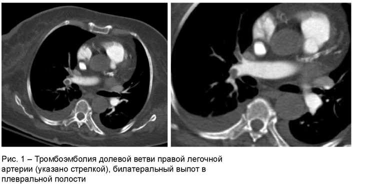 МСКТ с болюсным контрастированием в диагностике тромбоэмболии легочной артерии
