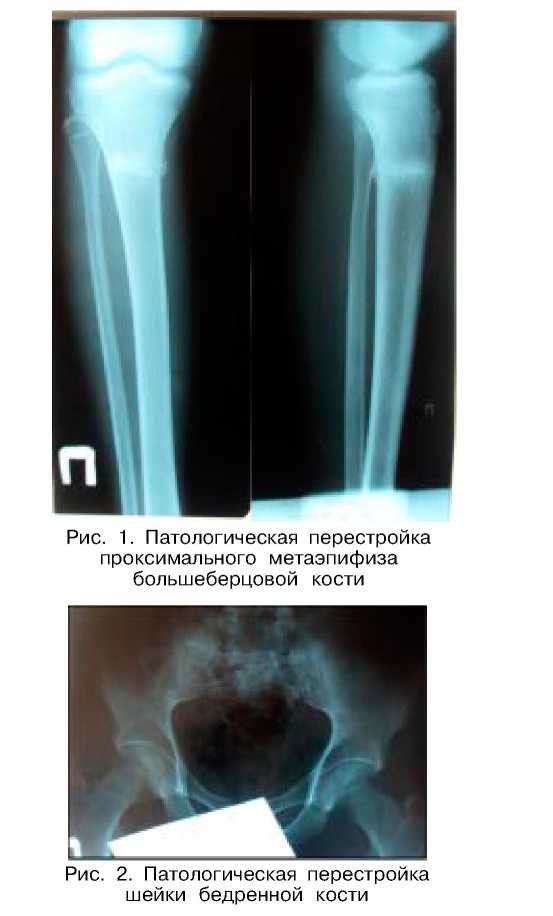 Диагностика и лечение патологической перестройки длинных трубчатых костей нижних конечностей у военнослужащих