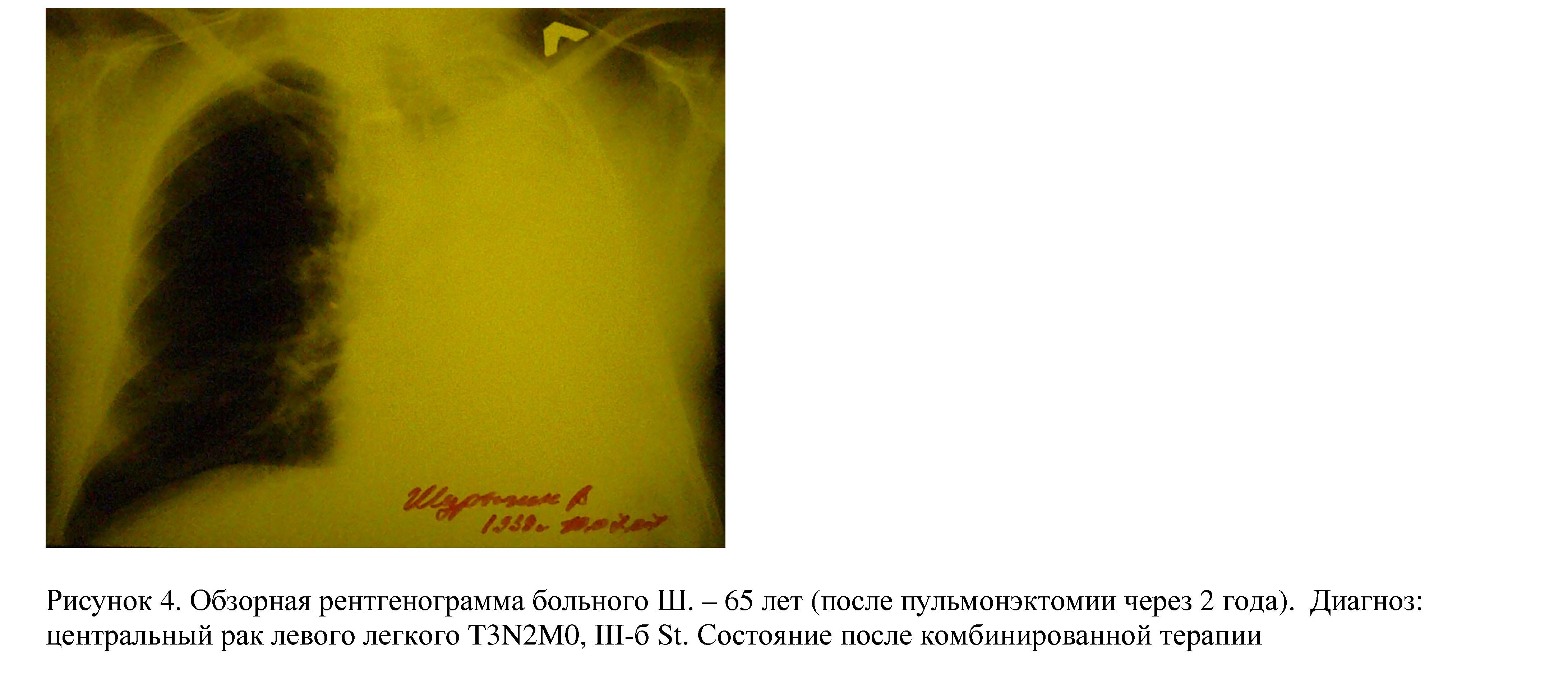 Способ комбинированного лечения больных раком желудка