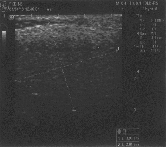  Ультразвуковая эхограмма околоушной слюнной железы слева б-ой Д.А., 41 год