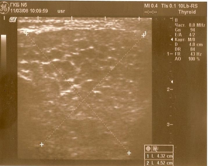 Ультразвуковая эхограмма околоушной слюнной железы б-ой Ш., 42 лет