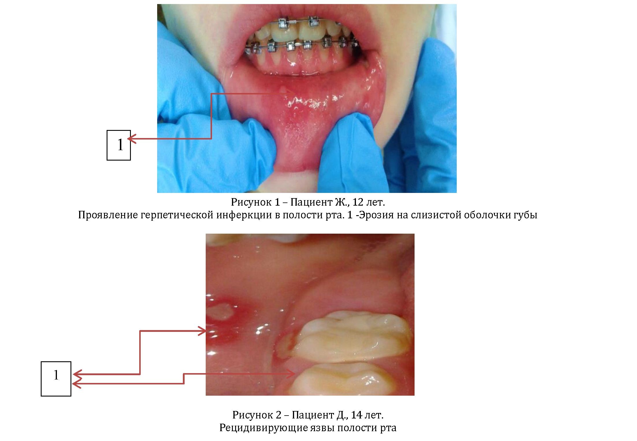 Ретроспективный анализ стоматологического здоровья у вич-инфицированных детей