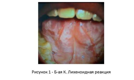 Особенности проявления красного плоского лишая в полости рта