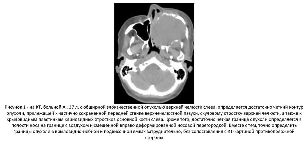 Определение границ и распространенности опухолей и деструктивных опухолеподобных заболеваний челюстно-лицевой области по данным компьютерной томографии
