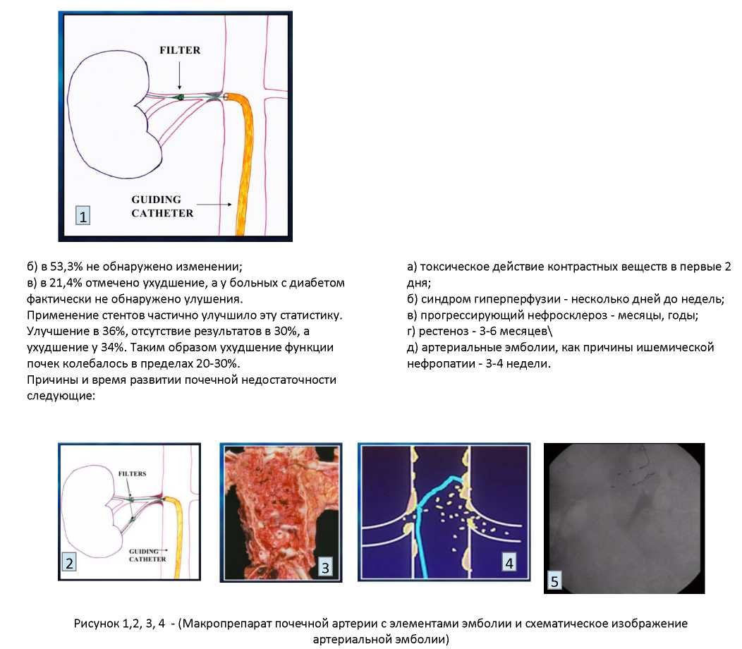 Реноваскулярная гипертония.Радикальное лечение методом стентирования почечной артерии с применением  антиэмболизационных приспособлений