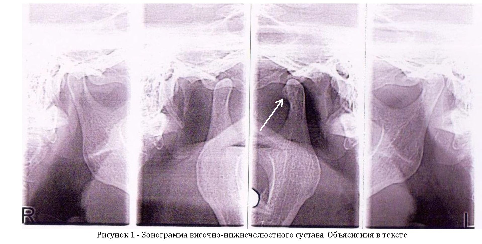 Редкий случай субхондральной кисты при остеоартрозе височно- нижнечелюстного сустава