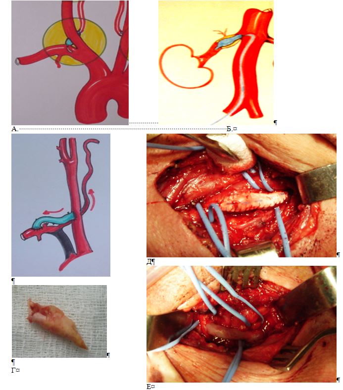 Схема транслюминальной баллонной ангиопластики правой позвоночной и правой почечных артерий (а-б). Схема сонно-подключичного аутовенозного шунтирования (в). Интраоперационное фото – ате-росклеротическая бляшка из левой внутренней сонной артерии (г). Интраоперационное фото – наложен аутовенозный шунт (д). Интраоперационное фото – выполнена каротидная эндартерэктомия левой внут-ренней сонной артерии с боковой аллопластикой из заплаты Гортекс (д).