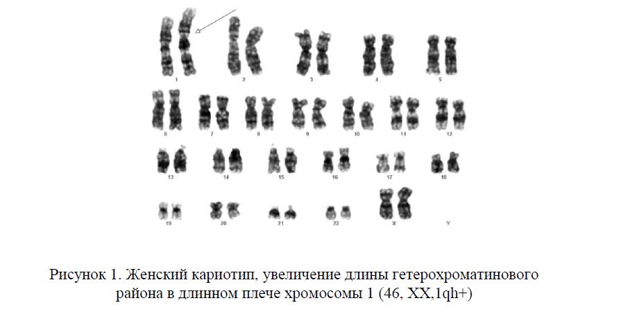 Влияние полиморфных вариантов хромосом на результативность программ вспомогательных репродуктивных технологий